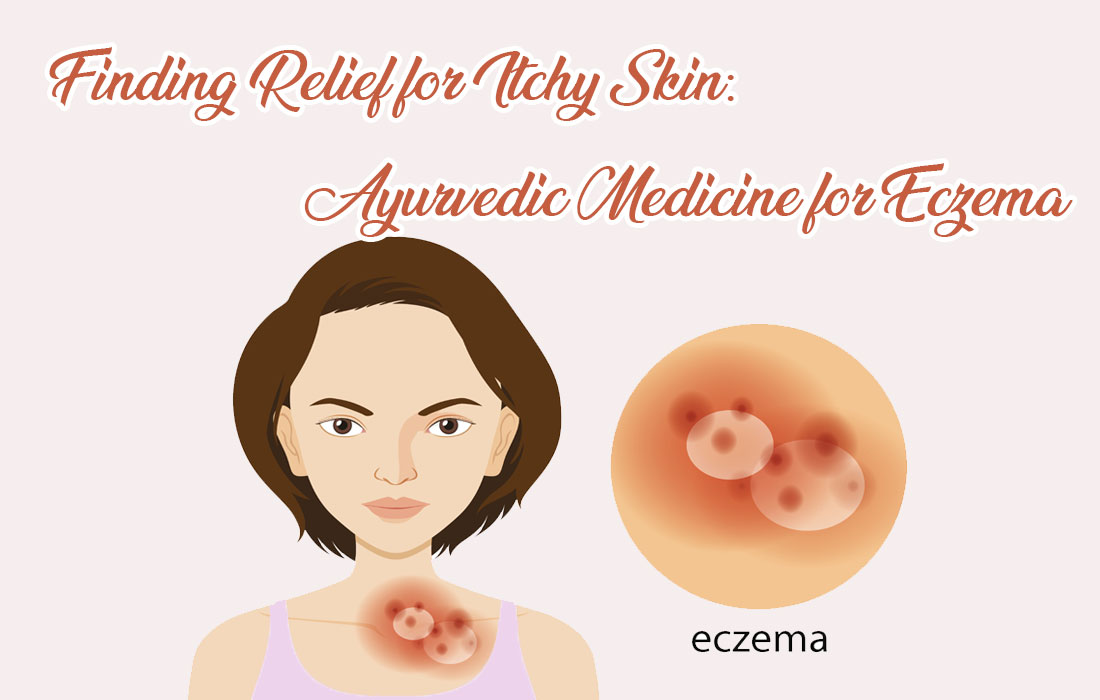 Finding Relief for Itchy Skin: Ayurvedic Medicine for Eczema