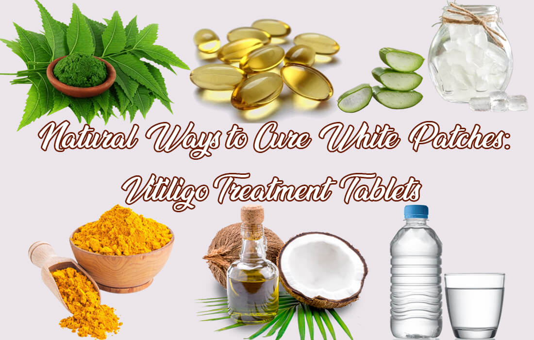 Natural Ways to Cure White Patches: Vitiligo Treatment Tablets